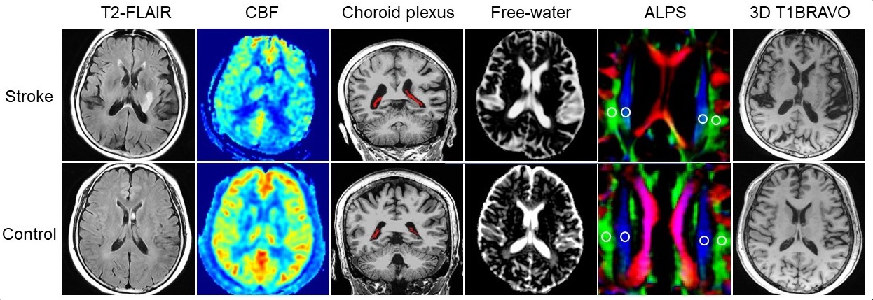 Representative T2-FLAIR, CBF maps, choroid plexus segment, free-water maps, ALPS ROI, and 3D T1BRAVO from a stroke patient, and a healthy control. Both individuals are 64 years old in chronological age. The patient displays an evident ischemic lesion in the basal ganglia region on T2-FLAIR imaging. The distinctions between the patient and the healthy control are as follows: CBF (32.22 ml/100g/min vs. 47.70 ml/100g/min), CPVF (1.47 vs. 0.84), VCSFVF (32.50 vs. 11.00), MSFW (0.0455 vs. 0.0313), ALPS (1.04 vs. 1.54), and BPAD (13.21 vs. -1.60).
