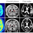 Representative T2-FLAIR, CBF maps, choroid plexus segment, free-water maps, ALPS ROI, and 3D T1BRAVO from a stroke patient, and a healthy control. Both individuals are 64 years old in chronological age. The patient displays an evident ischemic lesion in the basal ganglia region on T2-FLAIR imaging. The distinctions between the patient and the healthy control are as follows: CBF (32.22 ml/100g/min vs. 47.70 ml/100g/min), CPVF (1.47 vs. 0.84), VCSFVF (32.50 vs. 11.00), MSFW (0.0455 vs. 0.0313), ALPS (1.04 vs. 1.54), and BPAD (13.21 vs. -1.60).
