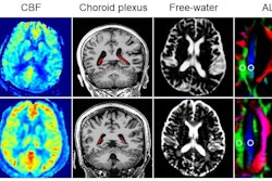 Representative T2-FLAIR, CBF maps, choroid plexus segment, free-water maps, ALPS ROI, and 3D T1BRAVO from a stroke patient, and a healthy control. Both individuals are 64 years old in chronological age. The patient displays an evident ischemic lesion in the basal ganglia region on T2-FLAIR imaging. The distinctions between the patient and the healthy control are as follows: CBF (32.22 ml/100g/min vs. 47.70 ml/100g/min), CPVF (1.47 vs. 0.84), VCSFVF (32.50 vs. 11.00), MSFW (0.0455 vs. 0.0313), ALPS (1.04 vs. 1.54), and BPAD (13.21 vs. -1.60).