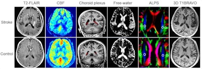 Representative T2-FLAIR, CBF maps, choroid plexus segment, free-water maps, ALPS ROI, and 3D T1BRAVO from a stroke patient, and a healthy control. Both individuals are 64 years old in chronological age. The patient displays an evident ischemic lesion in the basal ganglia region on T2-FLAIR imaging. The distinctions between the patient and the healthy control are as follows: CBF (32.22 ml/100g/min vs. 47.70 ml/100g/min), CPVF (1.47 vs. 0.84), VCSFVF (32.50 vs. 11.00), MSFW (0.0455 vs. 0.0313), ALPS (1.04 vs. 1.54), and BPAD (13.21 vs. -1.60).
