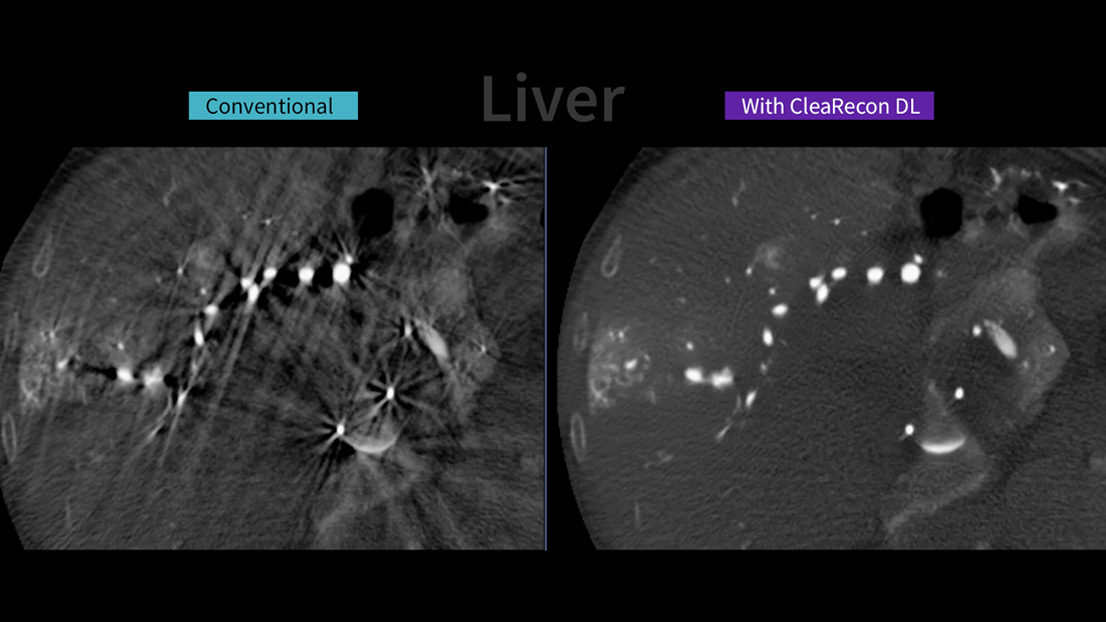 Images compare CBCT liver images with and without the CleaRecon DL system.