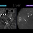 Images compare CBCT liver images with and without the CleaRecon DL system.