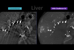Images compare CBCT liver images with and without the CleaRecon DL system.