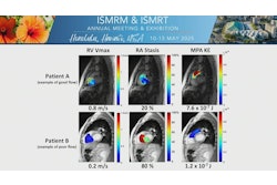 Examples of hemodynamic parameter maps superimposed on their corresponding anatomic data for two participants. Participant A represents an example of good flow with lower right ventricle stasis, increased right atrium kinetic energy, and increased mean velocity when compared to the sample’s average calculations. Opposite findings are highlighted by the visualizations of participant B representing an example of poor flow.