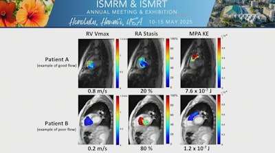 Examples of hemodynamic parameter maps superimposed on their corresponding anatomic data for two participants. Participant A represents an example of good flow with lower right ventricle stasis, increased right atrium kinetic energy, and increased mean velocity when compared to the sample’s average calculations. Opposite findings are highlighted by the visualizations of participant B representing an example of poor flow.