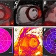 Myocardial involvement. Representative examples show fused PET/MRI images in patients with findings suggestive of myocarditis. (A and B) Short-axis view of increased F-18 FDG uptake in basal septum segments (A), colocalized with area of increased T2 values (B) on parametric mapping. (C and D) Prominent F-18 FDG uptake in middle anterolateral and inferolateral walls (C), matching area of increased T1 values (D). (E and F) Short-axis views of avid F-18 FDG uptake in basal inferior and inferolateral walls (E), matching areas of increased extracellular volume (F). SUV scale is 0-5 g/mL.