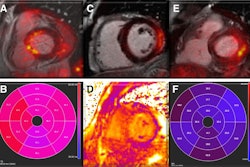 Myocardial involvement. Representative examples show fused PET/MRI images in patients with findings suggestive of myocarditis. (A and B) Short-axis view of increased F-18 FDG uptake in basal septum segments (A), colocalized with area of increased T2 values (B) on parametric mapping. (C and D) Prominent F-18 FDG uptake in middle anterolateral and inferolateral walls (C), matching area of increased T1 values (D). (E and F) Short-axis views of avid F-18 FDG uptake in basal inferior and inferolateral walls (E), matching areas of increased extracellular volume (F). SUV scale is 0-5 g/mL.