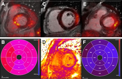 Myocardial involvement. Representative examples show fused PET/MRI images in patients with findings suggestive of myocarditis. (A and B) Short-axis view of increased F-18 FDG uptake in basal septum segments (A), colocalized with area of increased T2 values (B) on parametric mapping. (C and D) Prominent F-18 FDG uptake in middle anterolateral and inferolateral walls (C), matching area of increased T1 values (D). (E and F) Short-axis views of avid F-18 FDG uptake in basal inferior and inferolateral walls (E), matching areas of increased extracellular volume (F). SUV scale is 0-5 g/mL.