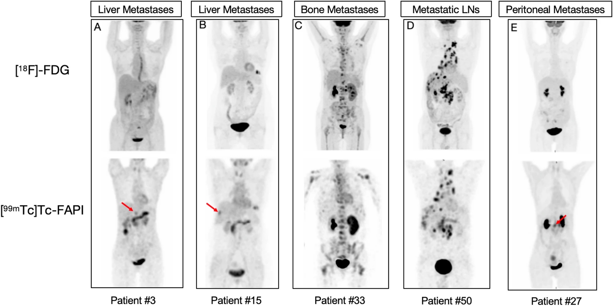 Representative F-18 FDG-PET/CT and Tc-99m FAPI-SPECT/CT scans for five study patients with gastrointestinal cancer. FDG-PET/CT and FAPI-SPECT/CT images show that uptake occurred in metastatic lymph nodes (LNs) (patient number 50, D) and bone metastases (patient number 33, C). FAPI-SPECT/CT outperformed FDG-PET/CT in detecting liver metastases (patient number 3, A; and 15,B) and peritoneal spread metastases (patient number 27, E). Red arrows indicate foci additionally found by FAPI-SPECT/CT.