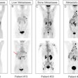 Representative F-18 FDG-PET/CT and Tc-99m FAPI-SPECT/CT scans for five study patients with gastrointestinal cancer. FDG-PET/CT and FAPI-SPECT/CT images show that uptake occurred in metastatic lymph nodes (LNs) (patient number 50, D) and bone metastases (patient number 33, C). FAPI-SPECT/CT outperformed FDG-PET/CT in detecting liver metastases (patient number 3, A; and 15,B) and peritoneal spread metastases (patient number 27, E). Red arrows indicate foci additionally found by FAPI-SPECT/CT.