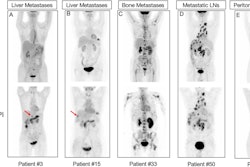 Representative F-18 FDG-PET/CT and Tc-99m FAPI-SPECT/CT scans for five study patients with gastrointestinal cancer. FDG-PET/CT and FAPI-SPECT/CT images show that uptake occurred in metastatic lymph nodes (LNs) (patient number 50, D) and bone metastases (patient number 33, C). FAPI-SPECT/CT outperformed FDG-PET/CT in detecting liver metastases (patient number 3, A; and 15,B) and peritoneal spread metastases (patient number 27, E). Red arrows indicate foci additionally found by FAPI-SPECT/CT.