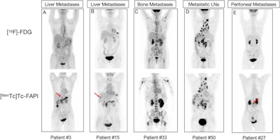 Representative F-18 FDG-PET/CT and Tc-99m FAPI-SPECT/CT scans for five study patients with gastrointestinal cancer. FDG-PET/CT and FAPI-SPECT/CT images show that uptake occurred in metastatic lymph nodes (LNs) (patient number 50, D) and bone metastases (patient number 33, C). FAPI-SPECT/CT outperformed FDG-PET/CT in detecting liver metastases (patient number 3, A; and 15,B) and peritoneal spread metastases (patient number 27, E). Red arrows indicate foci additionally found by FAPI-SPECT/CT.