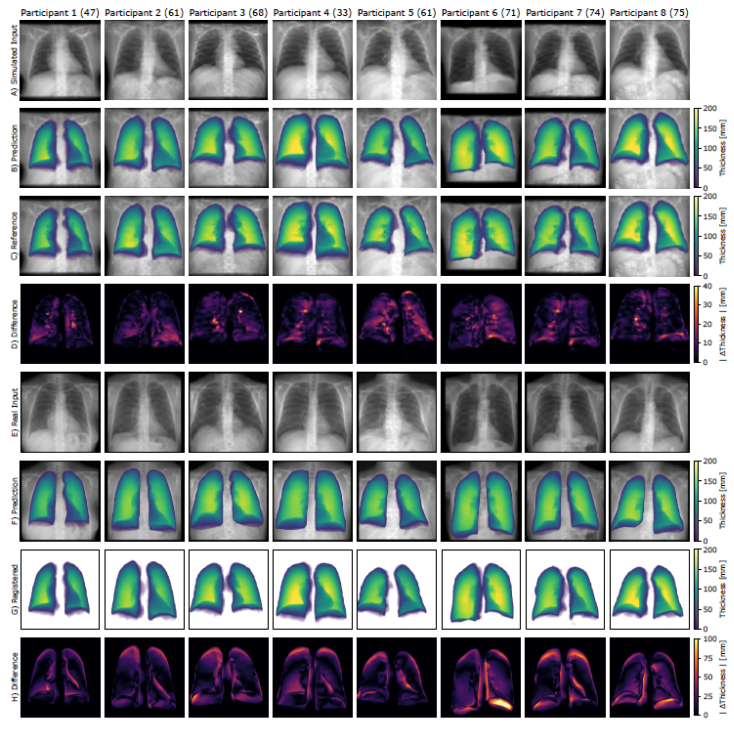 Qualitative results of eight frontal chest radiographs from the synthetic public test set, where each column represents one participant. Participants one through four are from the Luna16 test set, and participants five through eight are from the pulmonary embolism test set. (A) Simulated input radiographs, (B) predicted thickness maps, (C) reference standard thickness maps, and (D) absolute difference between the reference standard and predicted maps. The color bars for B and C indicate lung thickness in millimeters (mm). The color bar for D indicates the pixel-level estimation error in mm.