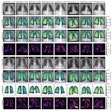 Qualitative results of eight frontal chest radiographs from the synthetic public test set, where each column represents one participant. Participants one through four are from the Luna16 test set, and participants five through eight are from the pulmonary embolism test set. (A) Simulated input radiographs, (B) predicted thickness maps, (C) reference standard thickness maps, and (D) absolute difference between the reference standard and predicted maps. The color bars for B and C indicate lung thickness in millimeters (mm). The color bar for D indicates the pixel-level estimation error in mm.