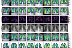 Qualitative results of eight frontal chest radiographs from the synthetic public test set, where each column represents one participant. Participants one through four are from the Luna16 test set, and participants five through eight are from the pulmonary embolism test set. (A) Simulated input radiographs, (B) predicted thickness maps, (C) reference standard thickness maps, and (D) absolute difference between the reference standard and predicted maps. The color bars for B and C indicate lung thickness in millimeters (mm). The color bar for D indicates the pixel-level estimation error in mm.