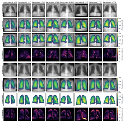Qualitative results of eight frontal chest radiographs from the synthetic public test set, where each column represents one participant. Participants one through four are from the Luna16 test set, and participants five through eight are from the pulmonary embolism test set. (A) Simulated input radiographs, (B) predicted thickness maps, (C) reference standard thickness maps, and (D) absolute difference between the reference standard and predicted maps. The color bars for B and C indicate lung thickness in millimeters (mm). The color bar for D indicates the pixel-level estimation error in mm.