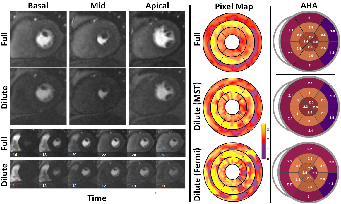 Representative stress perfusion CMR case with 80% contrast dose reduction. Pixel-wise MBF maps and AHA 16-segment bull's eye plots are shown for full-dose and reduced-dose acquisitions. When analyzed using the proposed MST deep learning method, the reduced-dose data closely matches the full-dose data across basal, mid, and apical slices. In contrast, Fermi-deconvolution shows good agreement in apical and mid slices but overestimates MBF in some basal segments, indicating reduced accuracy under low-dose conditions. Image courtesy of the ISMRM.