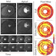 Representative stress perfusion CMR case with 80% contrast dose reduction. Pixel-wise MBF maps and AHA 16-segment bull's eye plots are shown for full-dose and reduced-dose acquisitions. When analyzed using the proposed MST deep learning method, the reduced-dose data closely matches the full-dose data across basal, mid, and apical slices. In contrast, Fermi-deconvolution shows good agreement in apical and mid slices but overestimates MBF in some basal segments, indicating reduced accuracy under low-dose conditions. Image courtesy of the ISMRM.