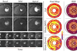 Representative stress perfusion CMR case with 80% contrast dose reduction. Pixel-wise MBF maps and AHA 16-segment bull's eye plots are shown for full-dose and reduced-dose acquisitions. When analyzed using the proposed MST deep learning method, the reduced-dose data closely matches the full-dose data across basal, mid, and apical slices. In contrast, Fermi-deconvolution shows good agreement in apical and mid slices but overestimates MBF in some basal segments, indicating reduced accuracy under low-dose conditions. Image courtesy of the ISMRM.