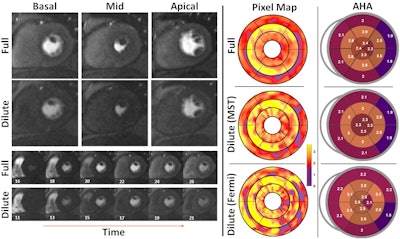 Representative stress perfusion CMR case with 80% contrast dose reduction. Pixel-wise MBF maps and AHA 16-segment bull's eye plots are shown for full-dose and reduced-dose acquisitions. When analyzed using the proposed MST deep learning method, the reduced-dose data closely matches the full-dose data across basal, mid, and apical slices. In contrast, Fermi-deconvolution shows good agreement in apical and mid slices but overestimates MBF in some basal segments, indicating reduced accuracy under low-dose conditions. Image courtesy of the ISMRM.