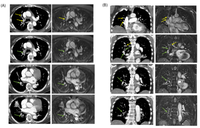Axial (A) and Coronal (B) CTPA show multiple partial intraluminal filling defects along the course of the right middle lobar segmental branches (medial segment) (yellow arrow) and lower lobar and postero-medial segmental branches (green arrow). Note the low-signal filling defects on the axial and coronal 0.55T MRI sequence.