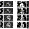Axial (A) and Coronal (B) CTPA show multiple partial intraluminal filling defects along the course of the right middle lobar segmental branches (medial segment) (yellow arrow) and lower lobar and postero-medial segmental branches (green arrow). Note the low-signal filling defects on the axial and coronal 0.55T MRI sequence.