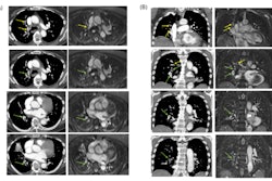Axial (A) and Coronal (B) CTPA show multiple partial intraluminal filling defects along the course of the right middle lobar segmental branches (medial segment) (yellow arrow) and lower lobar and postero-medial segmental branches (green arrow). Note the low-signal filling defects on the axial and coronal 0.55T MRI sequence.