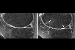 Knee Oa Mri izk S Gcx T6 B Thumbnail