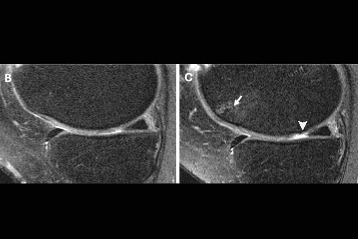 Steroid injections worsen knee degeneration in arthritis patients ...