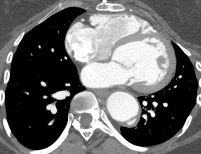 A 39-year-old woman with Marfan syndrome. Thickening of the mitral valve is in keeping with myxoid degeneration. Focal dissection of the descending aorta is also seen.