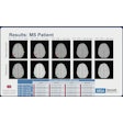 Results Ms Patient Highlight Main Li Ismrm2025