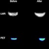 Researchers at ISMRM highlighted the success of a trimodal MR-PET-FUS system built around a low-field MRI scanner. MR (top) and PET (bottom) images were acquired simultaneously before and after FUS heating.