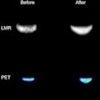 Researchers at ISMRM highlighted the success of a trimodal MR-PET-FUS system built around a low-field MRI scanner. MR (top) and PET (bottom) images were acquired simultaneously before and after FUS heating.