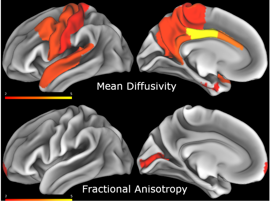 The hazard ratio for mean diffusivity and reciprocal of the hazard ratio for fractional anisotropy. Increases in mean diffusivity and decreases in fractional anisotropy are associated with a higher risk of conversion.