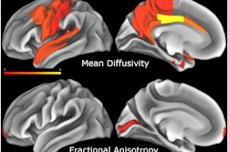 The hazard ratio for mean diffusivity and reciprocal of the hazard ratio for fractional anisotropy. Increases in mean diffusivity and decreases in fractional anisotropy are associated with a higher risk of conversion.