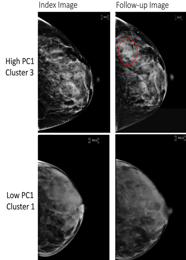 Full-field digital mammography (FFDM) images in a 52-year-old woman show a high-risk phenotype (top), and FFDM images in a 58-year-old woman show a low-risk phenotype (bottom). The high-risk phenotype was defined by having high values of the first principal component (PC1) and was assigned to cluster 3 (top row), and the low-risk phenotype was defined by having low values of the PC1 and was assigned to cluster 1 (bottom row). The index images (left side; before any diagnosis of cancer) are provided as well as follow-up images obtained at either the time of cancer diagnosis (for the high-risk phenotype, top right) or at the last follow-up (low-risk phenotype, bottom right). The red circle indicates the location of subsequent breast cancer. Both women had a BI-RADS breast density of C. The woman at high risk for breast cancer was Black and the woman at low risk for breast cancer was white.