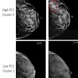 Full-field digital mammography (FFDM) images in a 52-year-old woman show a high-risk phenotype (top), and FFDM images in a 58-year-old woman show a low-risk phenotype (bottom). The high-risk phenotype was defined by having high values of the first principal component (PC1) and was assigned to cluster 3 (top row), and the low-risk phenotype was defined by having low values of the PC1 and was assigned to cluster 1 (bottom row). The index images (left side; before any diagnosis of cancer) are provided as well as follow-up images obtained at either the time of cancer diagnosis (for the high-risk phenotype, top right) or at the last follow-up (low-risk phenotype, bottom right). The red circle indicates the location of subsequent breast cancer. Both women had a BI-RADS breast density of C. The woman at high risk for breast cancer was Black and the woman at low risk for breast cancer was white.