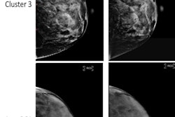 Full-field digital mammography (FFDM) images in a 52-year-old woman show a high-risk phenotype (top), and FFDM images in a 58-year-old woman show a low-risk phenotype (bottom). The high-risk phenotype was defined by having high values of the first principal component (PC1) and was assigned to cluster 3 (top row), and the low-risk phenotype was defined by having low values of the PC1 and was assigned to cluster 1 (bottom row). The index images (left side; before any diagnosis of cancer) are provided as well as follow-up images obtained at either the time of cancer diagnosis (for the high-risk phenotype, top right) or at the last follow-up (low-risk phenotype, bottom right). The red circle indicates the location of subsequent breast cancer. Both women had a BI-RADS breast density of C. The woman at high risk for breast cancer was Black and the woman at low risk for breast cancer was white.