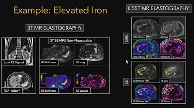 A study presented at ISMRM 2025 found that MR elastography at 0.55-tesla can produce high-quality images comparable to that of the modality's 3-tesla counterpart.