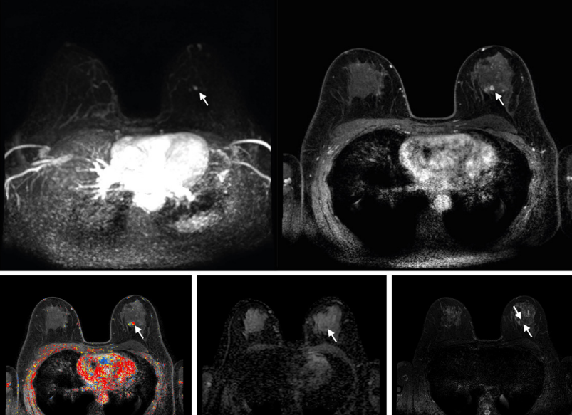 Abbreviated axial MRI images show a 7-mm irregular mass with irregular margin (arrows) in the right upper inner quadrant with early rapid enhancement (BIRADS 4). The participant was recalled and underwent an MRI-guided vacuum-assisted biopsy that showed sclerosing adenosis with microcalcifications and usual ductal hyperplasia and focal apocrine metaplasia. On the full-protocol images (not shown), the lesion was T2-weighted hypointense and showed diffusion restriction and washout kinetics in the delayed phase, characteristics that would not have reversed the decision to recall the participant.