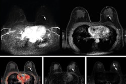 Abbreviated axial MRI images show a 7-mm irregular mass with irregular margin (arrows) in the right upper inner quadrant with early rapid enhancement (BIRADS 4). The participant was recalled and underwent an MRI-guided vacuum-assisted biopsy that showed sclerosing adenosis with microcalcifications and usual ductal hyperplasia and focal apocrine metaplasia. On the full-protocol images (not shown), the lesion was T2-weighted hypointense and showed diffusion restriction and washout kinetics in the delayed phase, characteristics that would not have reversed the decision to recall the participant.