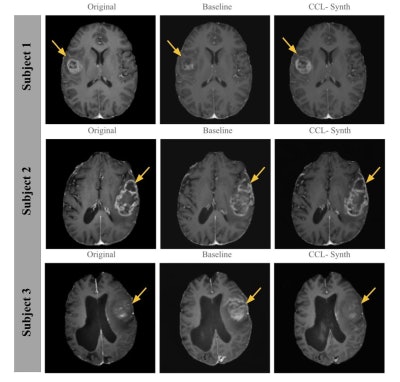 Comparison of T1-CE images generated by the CCL-Synth model with ground truth and baseline results for three subjects. Yellow arrows indicate key regions where the CCL-Synth model achieves improved tumor conspicuity, enhancing visualization of tumor margins and internal structures compared to the baseline. Images and caption courtesy of Lavanya Umapathy, PhD, and the ISMRM.