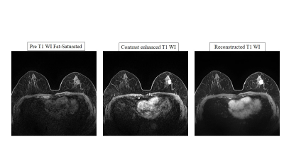Invasive breast cancer is detected in left breast as an enhancing irregular mass. The mass is well visualized on reconstructed T1 weighted image. Images and caption courtesy of Soonhoi Ha, PhD, and the ISMRM.