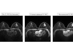 Invasive breast cancer is detected in left breast as an enhancing irregular mass. The mass is well visualized on reconstructed T1 weighted image. Images and caption courtesy of Soonhoi Ha, PhD, and the ISMRM.