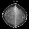 Thumbnail 71 Year Old Patient With History Of Left Breast Invasive Lobular Carcinoma Mindul Thumbnail