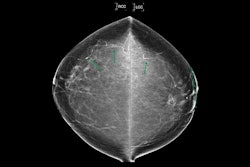 Thumbnail 71 Year Old Patient With History Of Left Breast Invasive Lobular Carcinoma Mindul Thumbnail