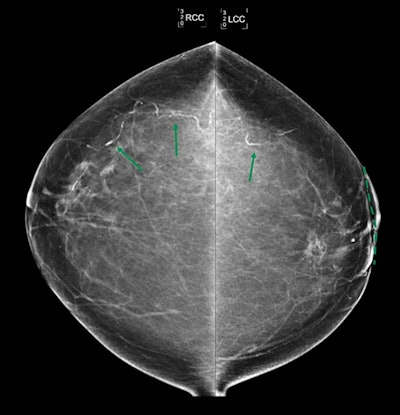 Bilateral craniocaudal views show bilateral breast arterial calcification in a 71-year-old patient with history of left breast invasive lobular carcinoma treated with wide local excision and radiation therapy with 50.4 Gy and 10 Gy boost to tumor bed (scar market indicated dashed line). Mammogram obtained 4 years after completion of radiation therapy. Breast arterial calcification is more extensive in untreated right breast than in left breast that received radiation therapy. Image and caption courtesy of the ARRS.