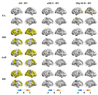 Group differences in the quantitative indices of SWM and GM. Significant group differences were found between AD - HV, aMCI – HV and Obj-SCD - HV (FDR-corrected p < 0.05). The yellow/red regions indicate higher values in patients and the light blue/dark blue regions indicate lower values in patients. The corrected p-value in each vertice was transformed as -log10(P) and the threshold is set by 1.3 - 3, which means that the vertices with FDR corrected p < 0.05 will have color. Graphic and caption courtesy of Yuchen Liu and the ISMRM.