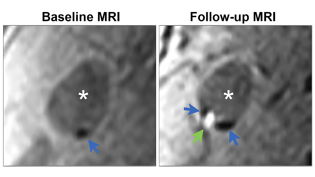 Demonstration of colocalization of pre-existing calcification and incident intraplaque hemorrhage (IPH) in the same plaque. Axial cross sections of the same plaque at the same arterial location on a scan obtained with a T1-weighted gradient-echo noncontrast MRI sequence in a 70-year-old female participant who was free of coronary heart disease and stroke before follow-up MRI. Baseline (left) and follow-up (right) MRI examinations. The blue arrows highlight calcification in a hypointense signal area, while the green arrow indicates IPH as a hyperintense signal. The asterisks mark the lumen of the carotid artery.