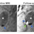Demonstration of colocalization of pre-existing calcification and incident intraplaque hemorrhage (IPH) in the same plaque. Axial cross sections of the same plaque at the same arterial location on a scan obtained with a T1-weighted gradient-echo noncontrast MRI sequence in a 70-year-old female participant who was free of coronary heart disease and stroke before follow-up MRI. Baseline (left) and follow-up (right) MRI examinations. The blue arrows highlight calcification in a hypointense signal area, while the green arrow indicates IPH as a hyperintense signal. The asterisks mark the lumen of the carotid artery.